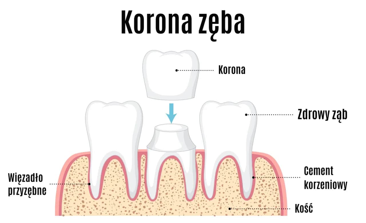 Wyrwanie zęba: Ile kosztuje i jak uniknąć ukrytych opłat?