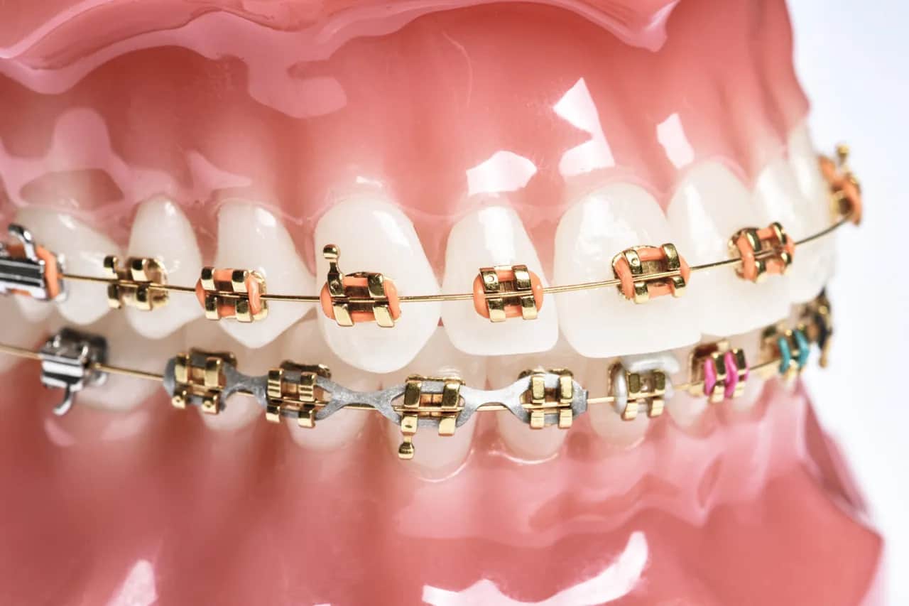 Czy aparat ortodontyczny powiększa usta? Rozwiewamy popularny mit!