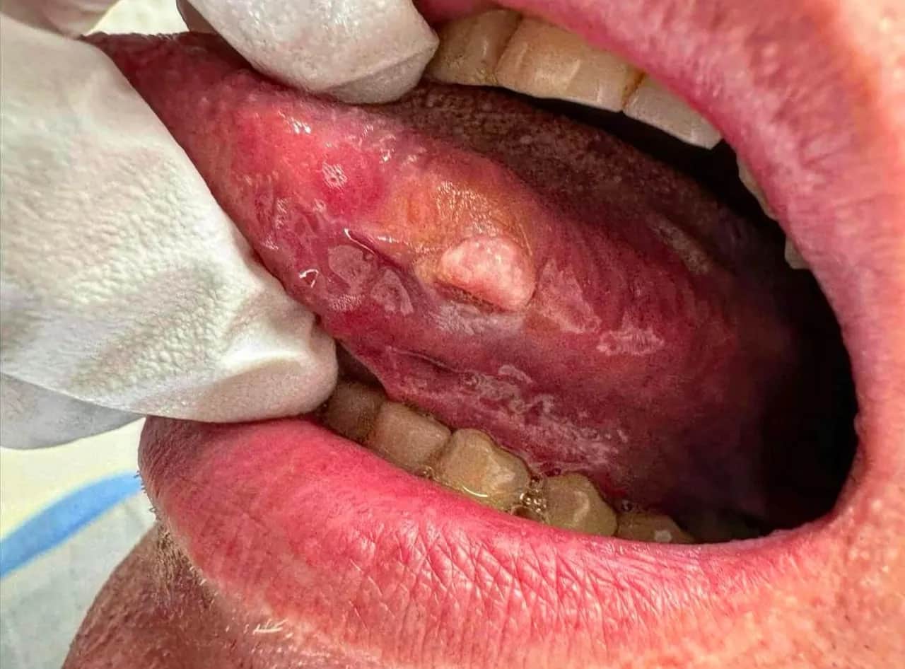 Rak jamy ustnej: Jak wygląda? Wczesne objawy, które ratują życie