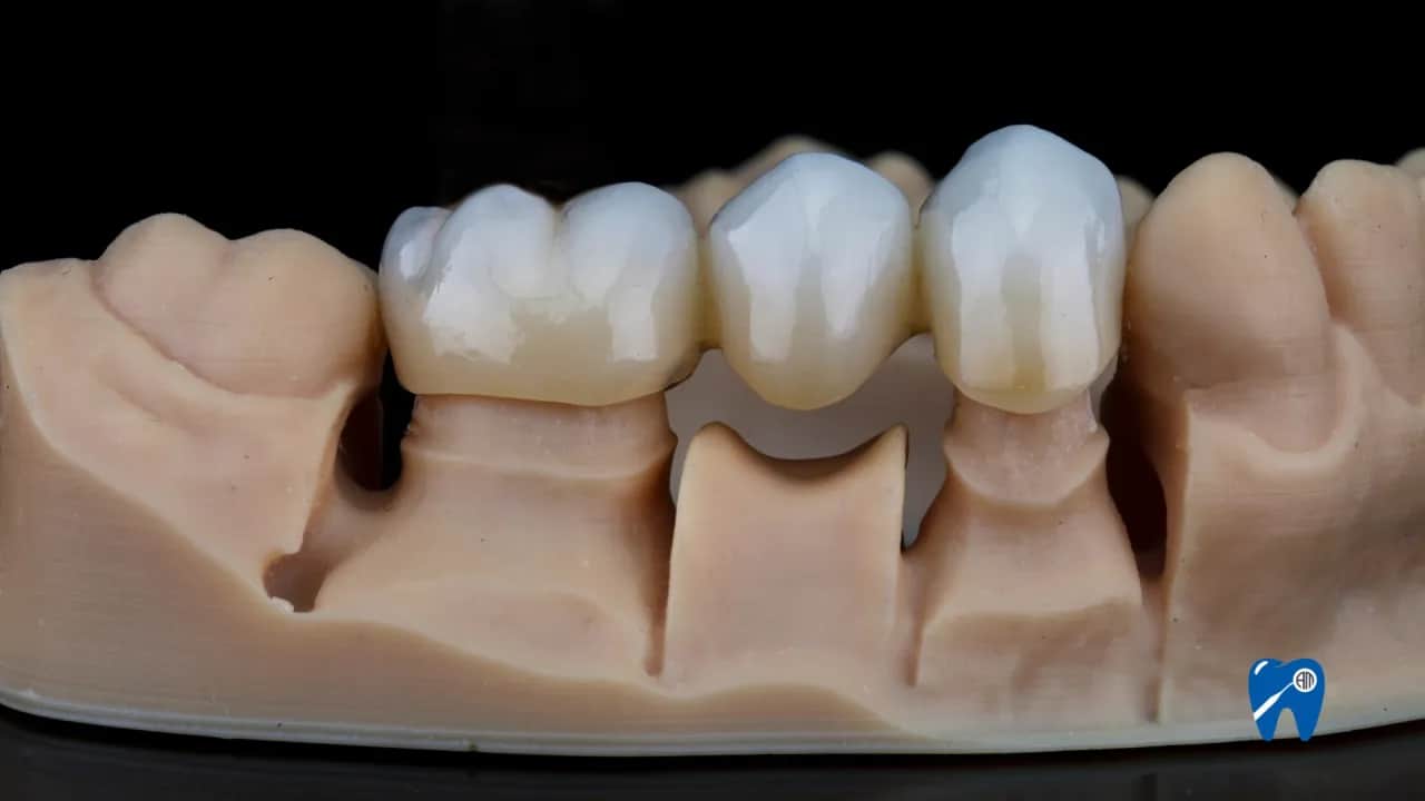 Gojenie dziąseł pod protezę: Ile trwa? Harmonogram i opieka