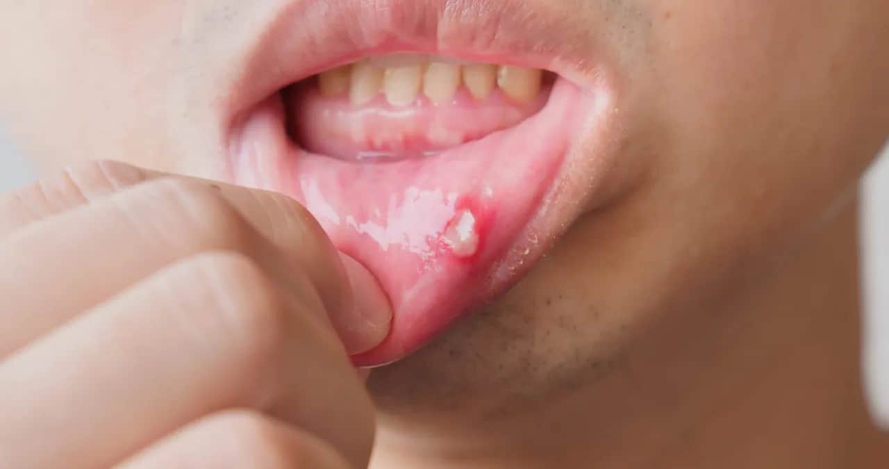Zapalenie jamy ustnej: objawy, przyczyny, leczenie i kiedy do lekarza?