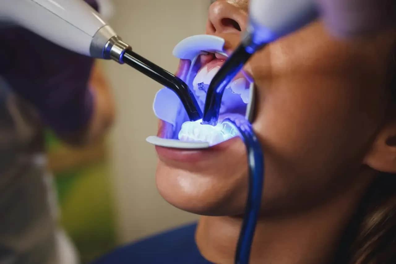 Jak wygląda wybielanie zębów u dentysty? Przewodnik krok po kroku