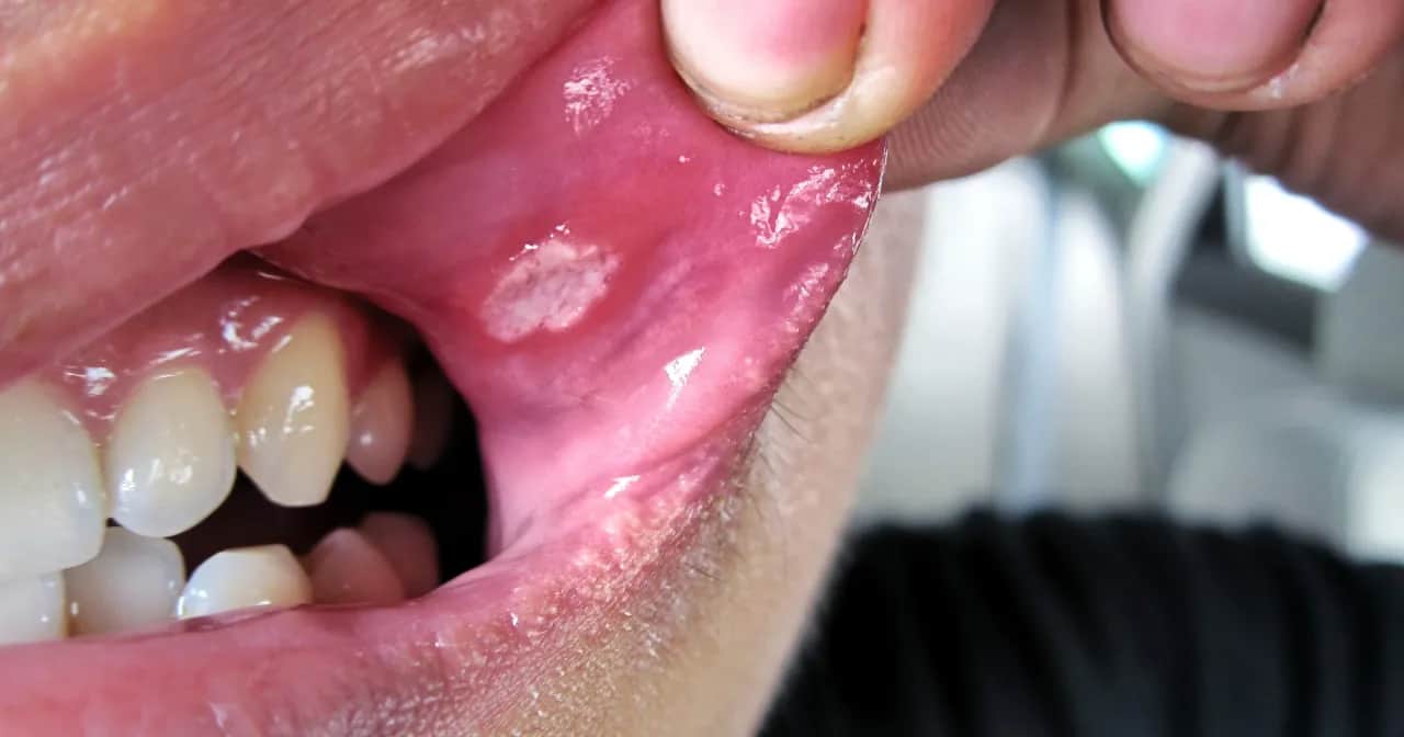 Objawy w jamie ustnej? Sprawdź, jakich witamin Ci brakuje!