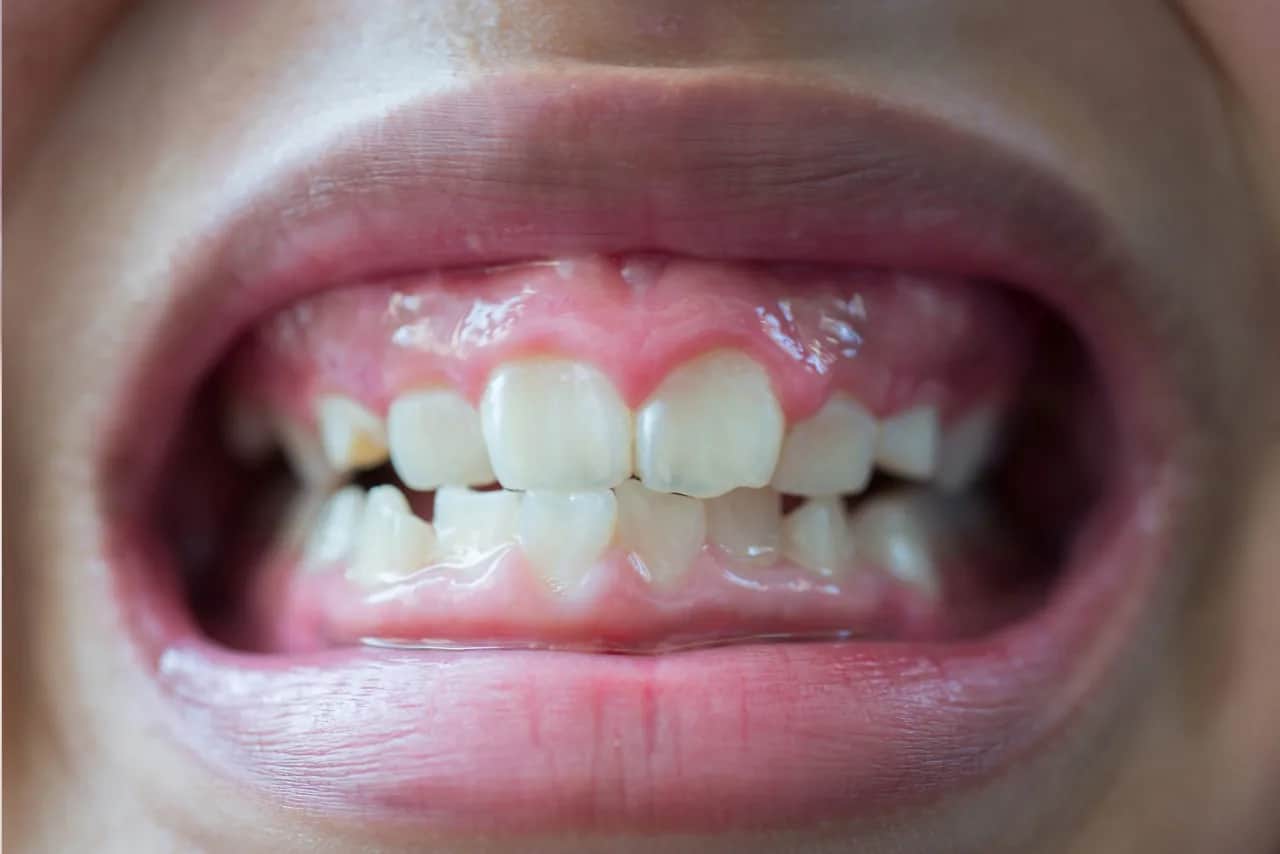 Czy to zapalenie dziąseł? Rozpoznaj objawy i działaj!